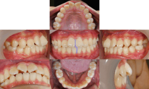 Read more about the article 성장기 총생과 2급 부정교합의 포괄적 교정 치료 – 치간삭제와 데이몬 브라켓을 이용하여 해결할 수 있을까?