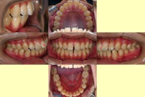 Read more about the article 혀내밀기 습관으로 앞니 사이 벌어짐 이? 비발치 교정 개선 과정