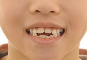 Read more about the article 어린이 부정교합 우리 아이 초등학생 치아교정이 고민된다면? 프리올소를 활용한 개선 과정 및 방법