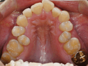Read more about the article 좁은 상악궁 확장(MARPE) 실패 후 위턱 첫번째 작은어금니 발치 교정 과정