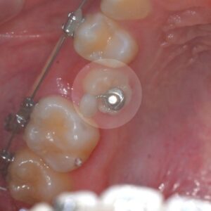 Read more about the article 잔존 유치로 인한 영구치 이소맹출 장애…해결책은?