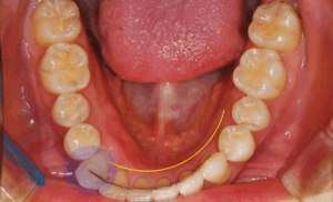 Read more about the article 재발된 총생 재교정치료로 앞니 교합 개선해야 되는 경우가 생길 수 있다?