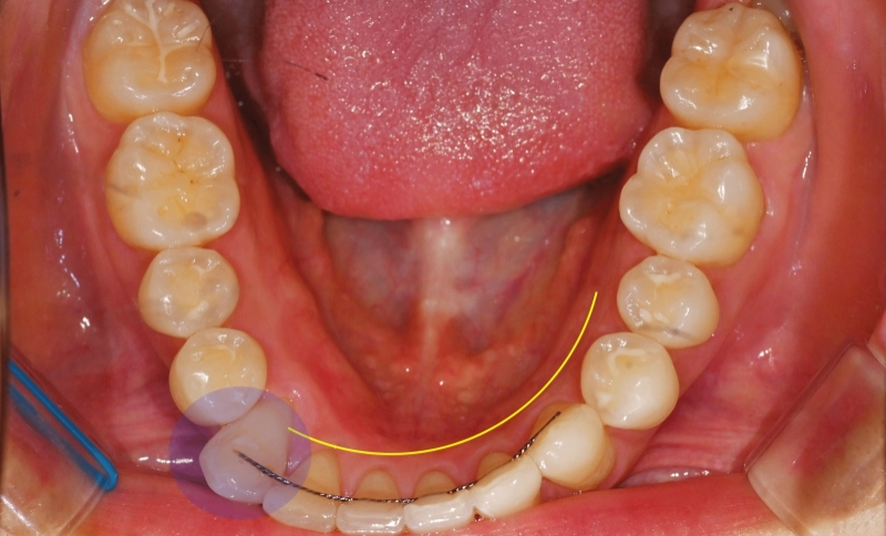 You are currently viewing 재발된 총생 재교정치료로 앞니 교합 개선해야 되는 경우가 생길 수 있다?