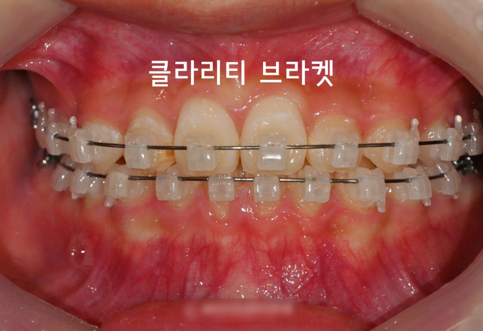 You are currently viewing 어린이 부정교합 3급 주걱턱 심미와 기능을 모두 갖춘 클라리티 브라켓 치아교정 으로 해결될까?