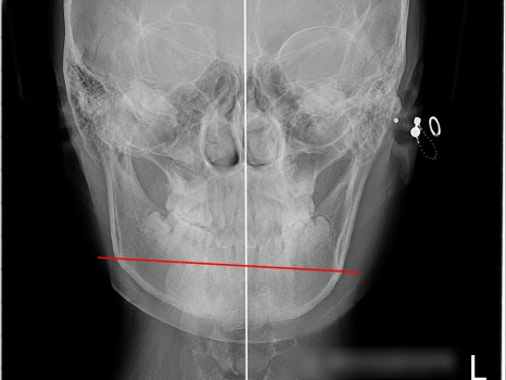 You are currently viewing MARPE 악궁 확장을 통한 안면 골격 비대칭, 횡적 부조화(transverse discrepancy) 개선 과정