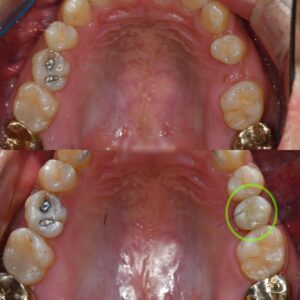 Read more about the article 임플란트 식립 전, 공간 확보를 위한 치아교정 사례