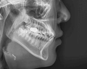 Read more about the article 좁은 상악궁 확장 교정치료, MARPE 장치를 활용한 교정 과정은?