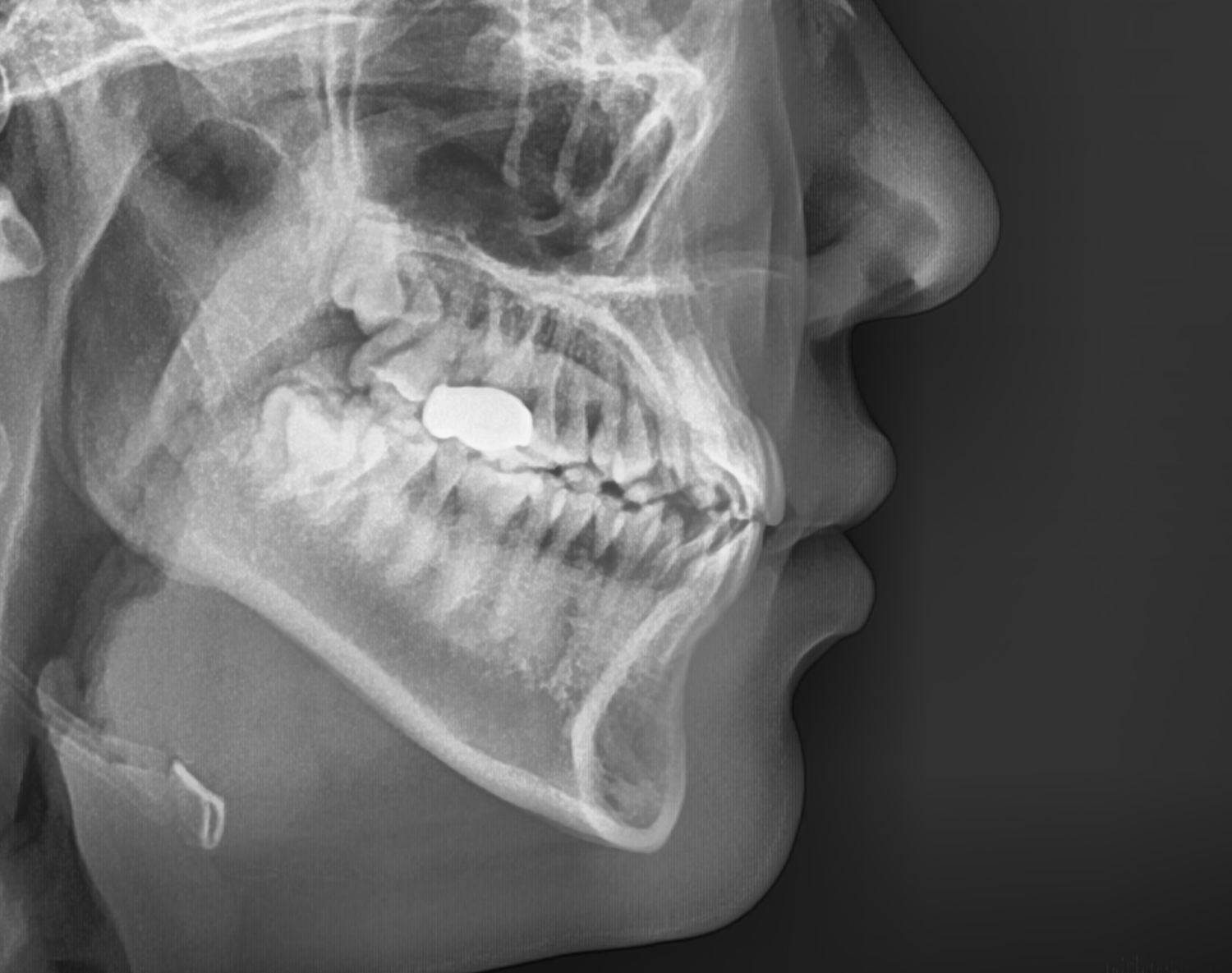 You are currently viewing 좁은 상악궁 확장 교정치료, MARPE 장치를 활용한 교정 과정은?