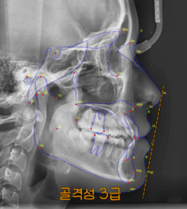 Read more about the article 절단 및 개방 교합, 주걱턱 고민, 수술 없이 비발치 치아 교정으로 해결한 케이스