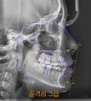 You are currently viewing 절단 및 개방 교합, 주걱턱 고민, 수술 없이 비발치 치아 교정으로 해결한 케이스