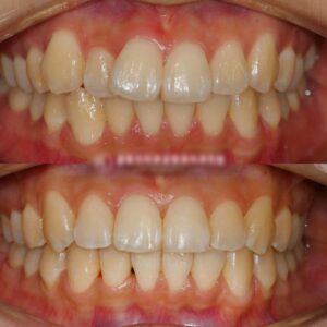 Read more about the article 가지런하지 않은 치아 배열, 비발치로 진행한 클리피씨 교정(Clippy-C) 장치 촬영, 신내동 치과 정보 전달성 글