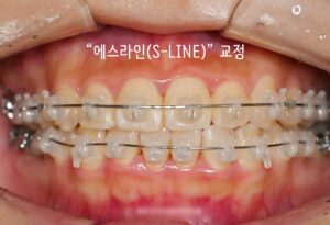 Read more about the article 에스라인(S-Line) 치아교정 세라믹 자가결찰 브라켓에 관련 된 글, 면목역 치과 에서 작성하는 의학 정보글