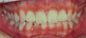 Read more about the article 삐뚤빼뚤한 치아, 윗니가 아랫니를 많이 덮는다면? 비발치 교정으로 해결한 총생 & 과개교합 케이스