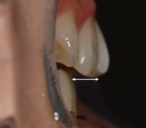 Read more about the article 아래 앞니 결손과 무턱, 인비절라인 교정과 임플란트 동반 치료 과정