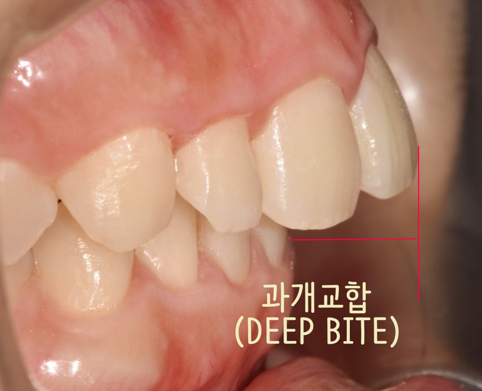 You are currently viewing 깊게 물리는 딥바이트 과개교합 편악발치로 치아 교정 진행 가능 여부에 관하여