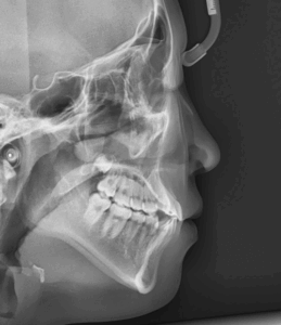 Read more about the article 반대교합 치료 이후 2차 교정, 왜 다시 해야 될까요?