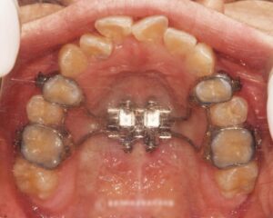 Read more about the article 틀어진 앞니 치아(총생)과 반대교합 사례, 면목동 치과 의 의학 정보 전달성 목적의 글