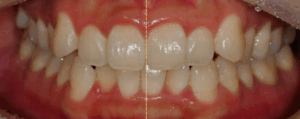 Read more about the article 삐뚤빼뚤한 덧니 치아 총생, 치간 삭제(IPR)를 이용한 비발치 교정 치료, 미니스크류 활용 케이스