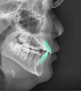 Read more about the article 우리 아이 치아 삐뚤삐뚤한데, 이대로 괜찮을까? 총생, 덧니 교정 치료 과정