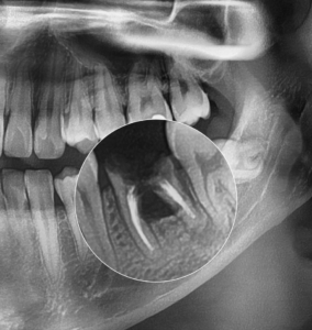 Read more about the article 손상된 치아 발치 후 임플란트 식립을 위한 교정 치료