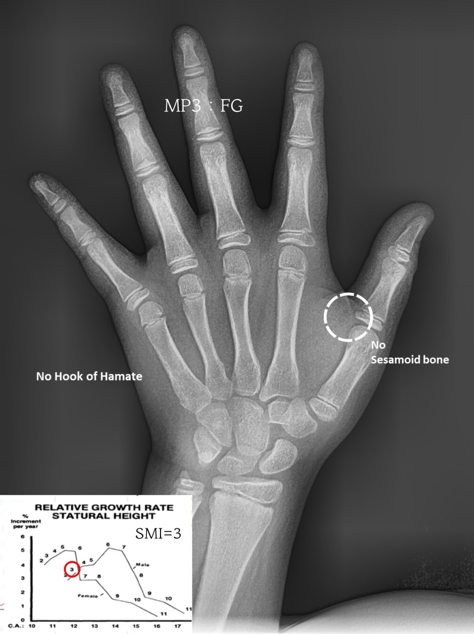 You are currently viewing 아이 영구치 덧니 치아 비발치 교정 치료 (과개교합 케이스)