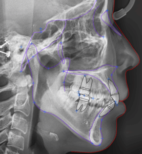 Read more about the article 돌출입 교정, 과개교합까지 한 번에 할 수 있을까? 비발치 치아 교정 과정