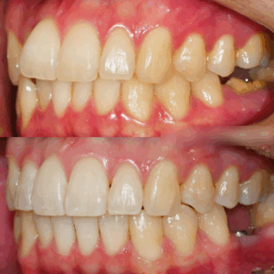 Read more about the article 임플란트 를 심고 싶은데 공간이 부족하다면? 비발치 치아 교정