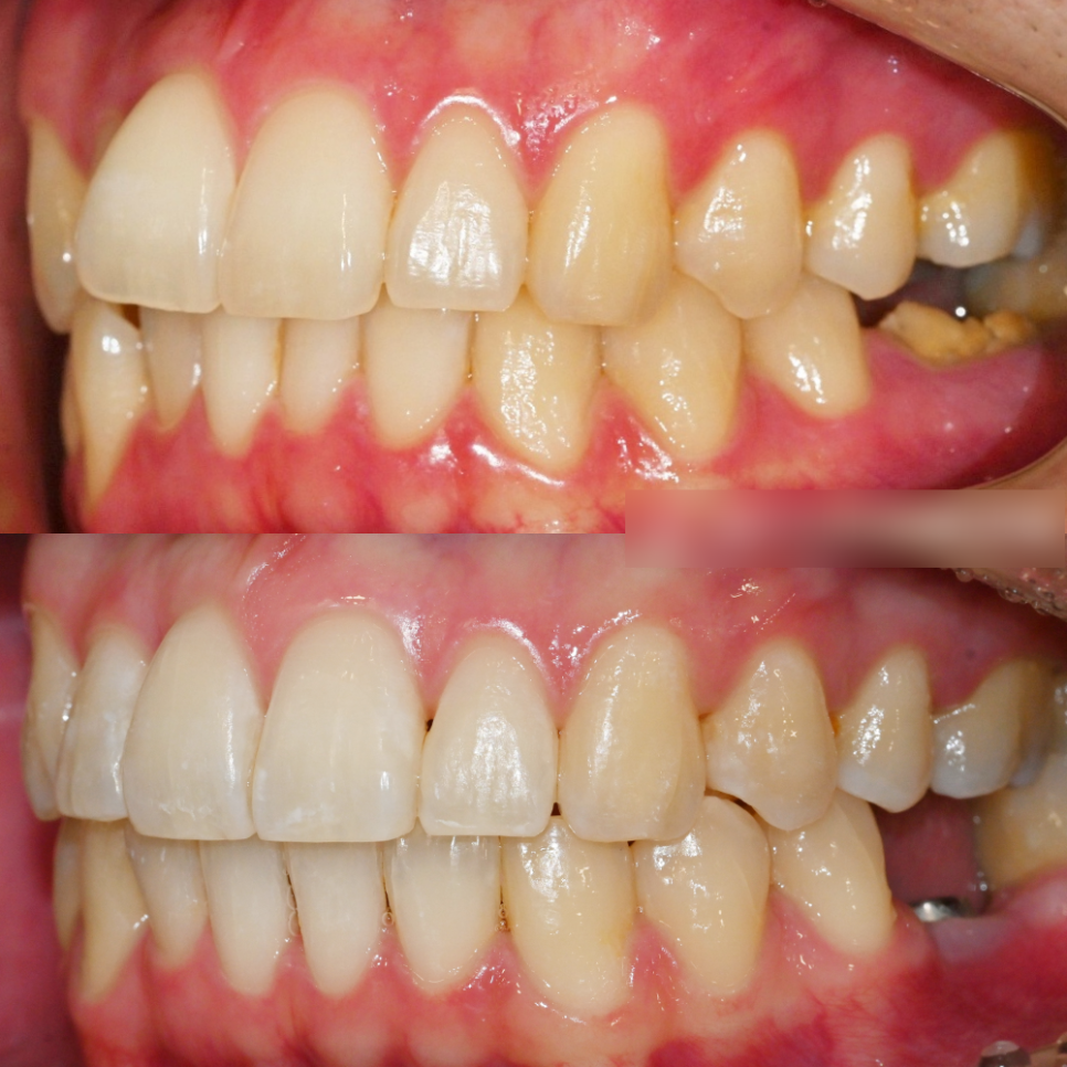 You are currently viewing 임플란트 를 심고 싶은데 공간이 부족하다면? 비발치 치아 교정