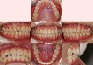 Read more about the article 왜소치 교정, 라미네이트와 크라운 없이 치료한 사례, 보철치료를 했을 때와의 차이점은?