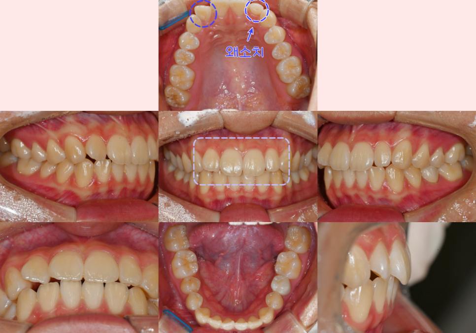 You are currently viewing 왜소치 교정, 라미네이트와 크라운 없이 치료한 사례, 보철치료를 했을 때와의 차이점은?