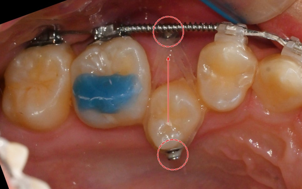 You are currently viewing 성인 이소맹출, 어금니 반대교합 총생(덧니)가 있을 때 치아 교정