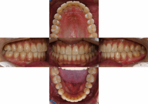 Read more about the article 삐뚤빼뚤한 치열 교정 비발치, 미니스크류 식립 케이스, 턱관절 검사