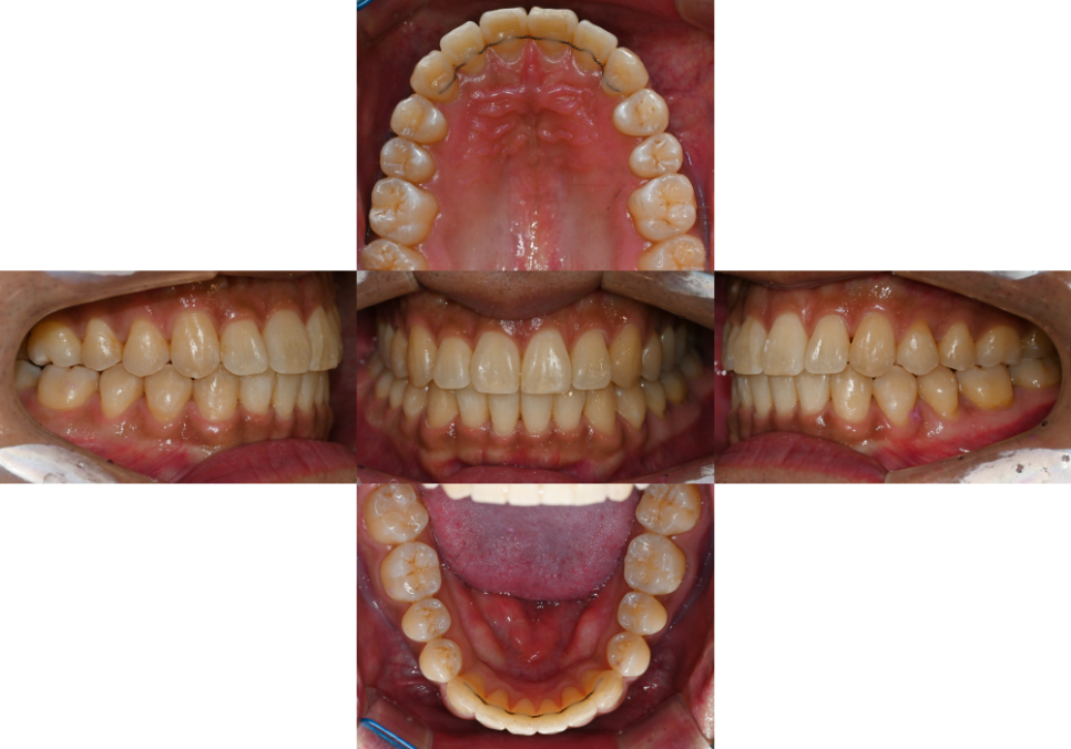 You are currently viewing 삐뚤빼뚤한 치열 교정 비발치, 미니스크류 식립 케이스, 턱관절 검사