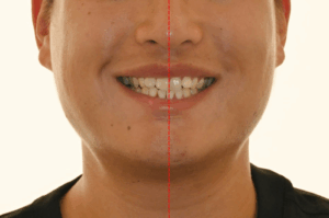 Read more about the article 영구치 덧니 미니스크류 를 활용한 비발치 옥니 교정, 클리피씨 브라켓 활용 케이스