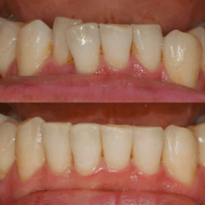 Read more about the article 미니 튜브로 해결하는 아랫니 덧니, 하악 부분 교정 치료 과정