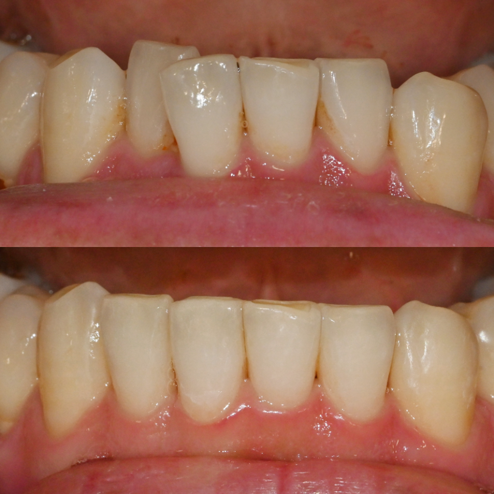 You are currently viewing 미니 튜브로 해결하는 아랫니 덧니, 하악 부분 교정 치료 과정