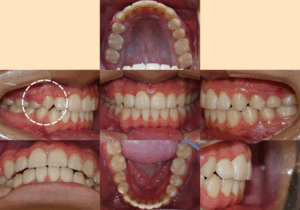 Read more about the article 웃을 때 살짝 보이는 덧니, 이제는 자신있게 웃어보세요 치아교정 케이스