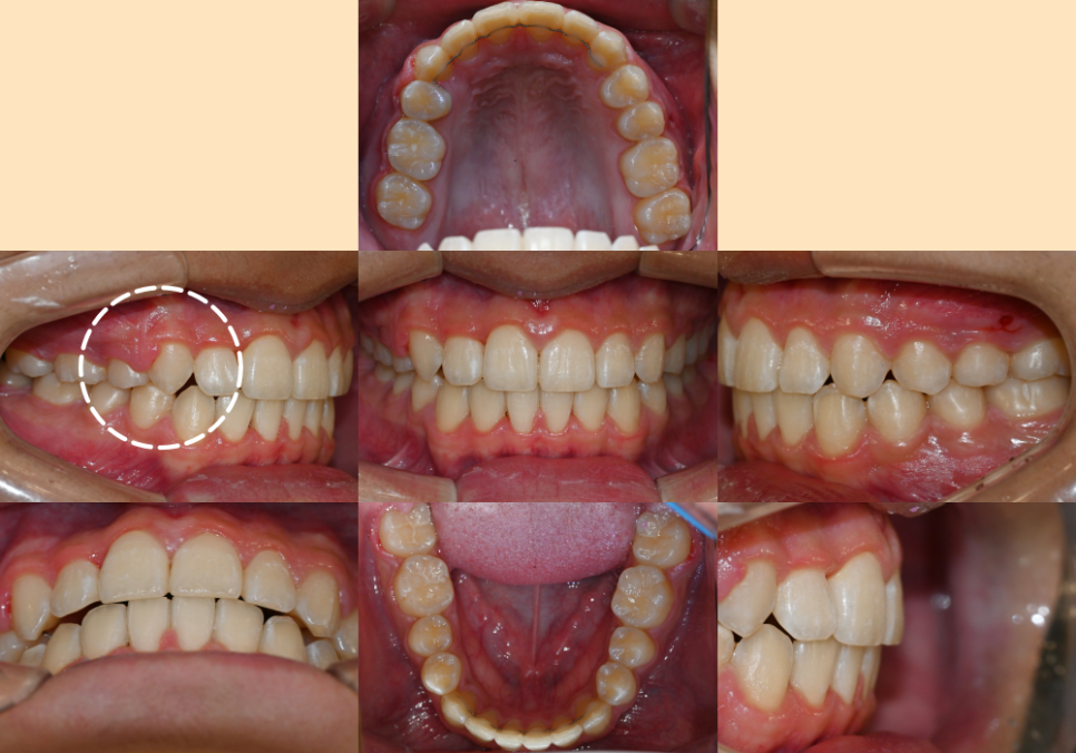 You are currently viewing 웃을 때 살짝 보이는 덧니, 이제는 자신있게 웃어보세요 치아교정 케이스