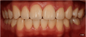 Read more about the article 매복치, 치근 흡수, 절단 교합, 정중선 불일치 등의 구강 문제, 임플란트 치아교정 으로 해결할 수 있을까요?