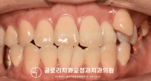 Read more about the article 중년 환자분의 고민은? 상봉역 치과 덧니 교정 과정 및 후기