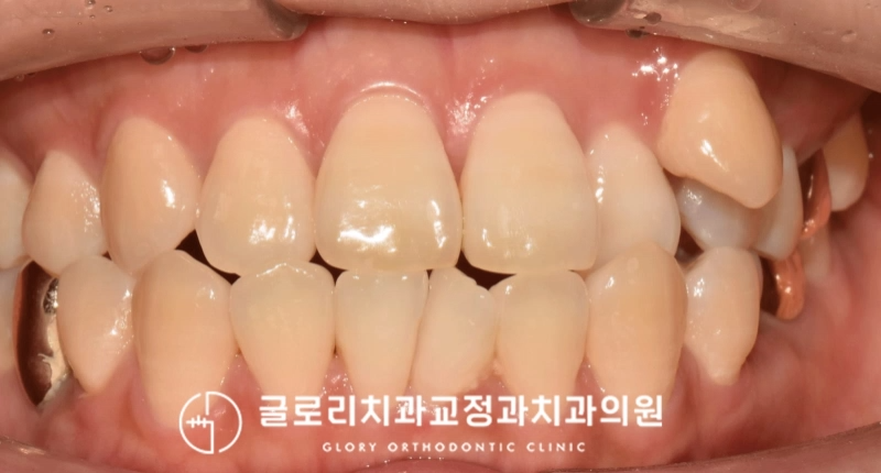 You are currently viewing 중년 환자분의 고민은? 상봉역 치과 덧니 교정 과정 및 후기