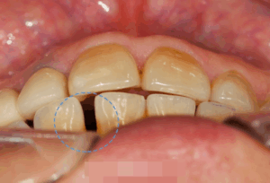 Read more about the article 보기 싫은 아랫니 이 사이 벌어짐, 부분교정을 진행하여 치아를 개선할 수 있을까?