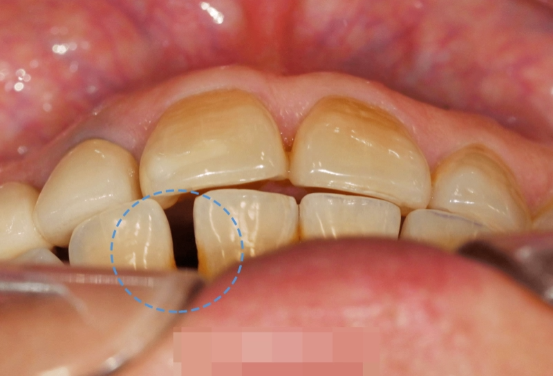 You are currently viewing 보기 싫은 아랫니 이 사이 벌어짐, 부분교정을 진행하여 치아를 개선할 수 있을까?