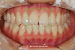 Read more about the article 앞니 틀어짐 윗니 부분교정으로 빠르고 간단하게 신내동 치과