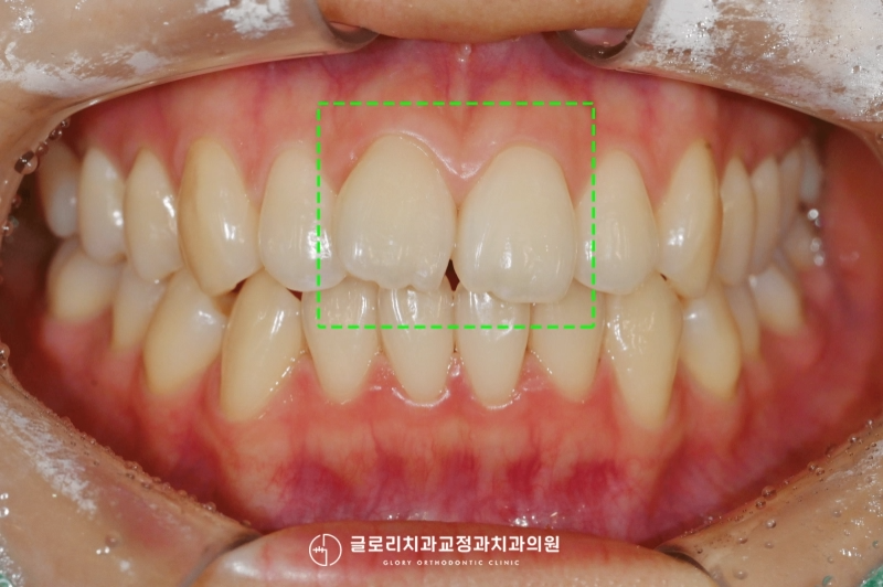 You are currently viewing 앞니 틀어짐 윗니 부분교정으로 빠르고 간단하게 신내동 치과