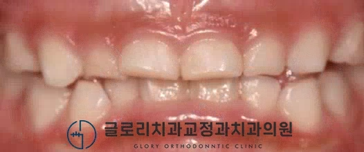 You are currently viewing 망우역 글로리 치과 페이스마스크를 동반한 어린이 주걱턱 개선 증례
