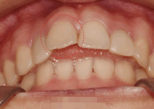 Read more about the article 토끼 이빨처럼 도드라져 보이는 치아 틀어짐 신내동 치과 에서 진행한 앞니 발치 교정