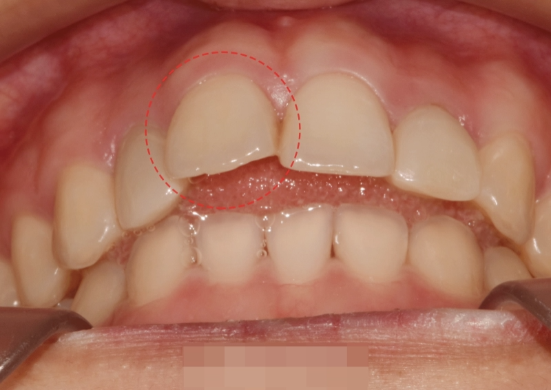 You are currently viewing 토끼 이빨처럼 도드라져 보이는 치아 틀어짐 신내동 치과 에서 진행한 앞니 발치 교정
