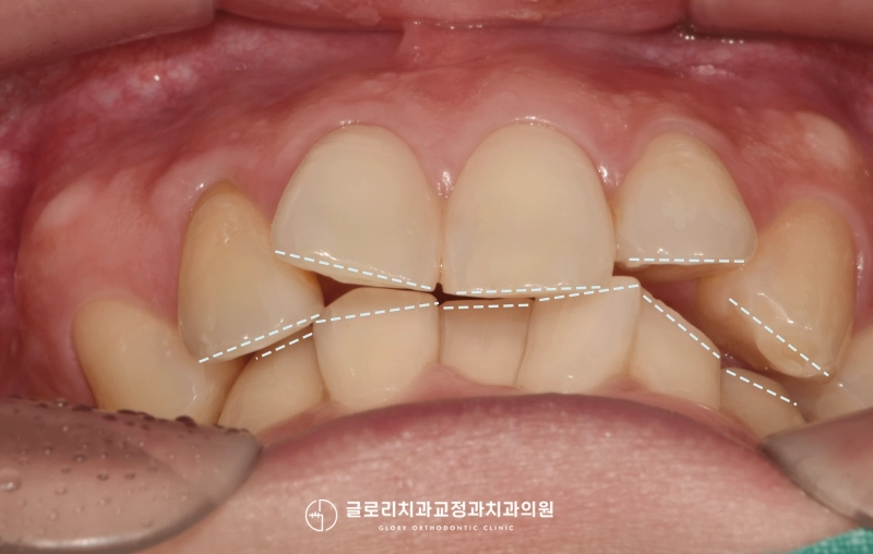 You are currently viewing 가지런하지 않은 앞니 배열과 과개교합 돌출입 치료 면목역 치과 에서 진행한 교정 케이스