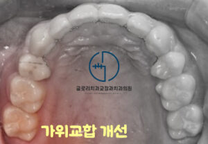 Read more about the article 어금니가 어긋난 가위교합(sissors bite) 방치하면 턱관절에도 영향을?! 면목동 교정치과
